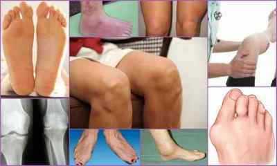 Гострий артроз колінного суглоба - симтомов і лікування