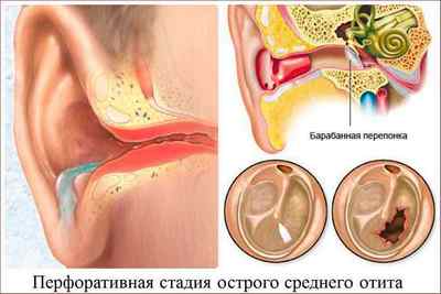 Гострий отит середнього вуха: симптоми і лікування