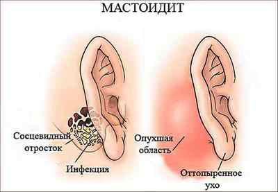 Гострий отит середнього вуха: симптоми і лікування