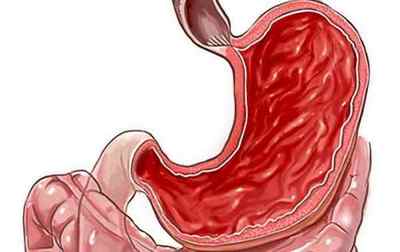 Гіперемована слизова шлунка: що це, з якими захворюваннями повязано