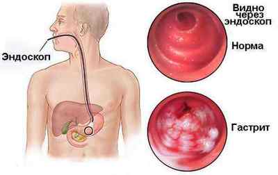 Гіперемована слизова шлунка: що це, з якими захворюваннями повязано
