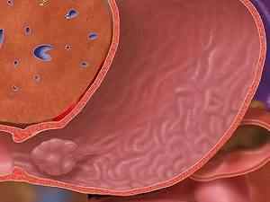 Гіперпластичний поліп шлунка: що це таке, чи потрібно видаляти, як лікувати