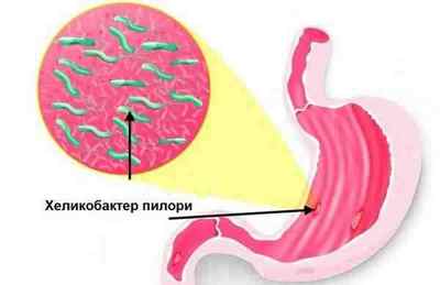 Гіперплазія шлунка: що це, форми і симптоми, лікування і дієта, прогноз