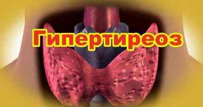 Гіпертиреоз щитовидної залози: симптоми і лікування