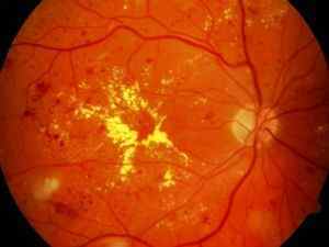 Гіпертонічна ангіопатія сітківки обох очей: лікування, причини