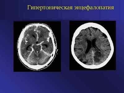 Гіпертонічна енцефалопатія головного мозку: симптоми і лікування