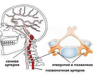 Гіпоплазія правої і лівої хребетної артерії: що це таке і лікування препаратами | Ревматолог