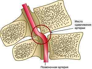 Гіпоплазія правої і лівої хребетної артерії: що це таке і лікування препаратами | Ревматолог