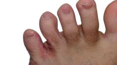 Грибок між пальцями ніг: симптоми і лікування