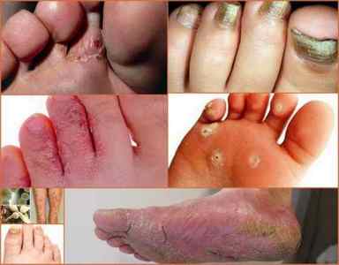 Грибок на ногах - причини, симптоми, лікування, фото