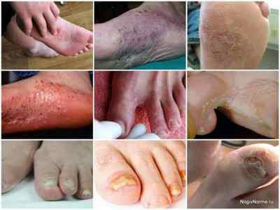 Грибок на ногах - причини, симптоми, лікування, фото