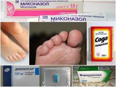 Грибок нігтів у дітей на ногах - лікування і фото