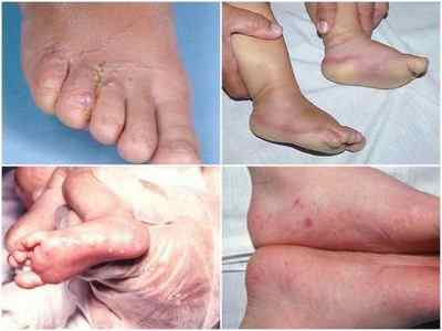 Грибок нігтів у дітей на ногах - лікування і фото