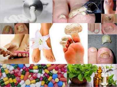 Грибок нігтя на великому пальці ноги: фото, симптоми, лікування