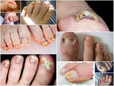 Грибок під нігтем на нозі - ознаки і лікування