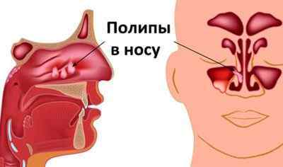 Грибок в носі: ознаки, симптоми і лікування