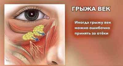 Грижі під очима: як позбутися без операції, способи прибрати, причини і лікування