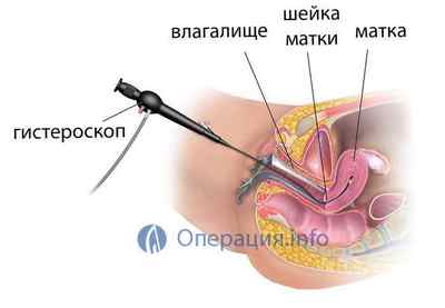 Гістероскопія матки: показання, проведення, результат