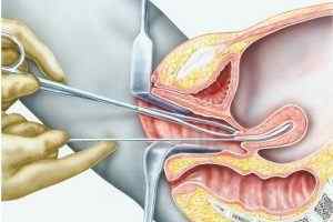 Гістероскопія при ендометріозі: показання та підготовка