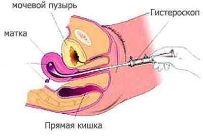 Гістероскопія при ендометріозі: показання та підготовка
