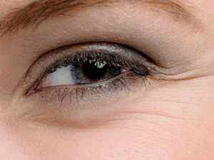 Гусячі лапки навколо очей: як прибрати, способи позбутися кремами, інєкціями та засобами