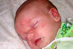 Харчова алергія у дитини: симптоми (з фото) і методи лікування