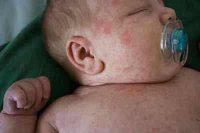 Харчова алергія у дитини: симптоми (з фото) і методи лікування