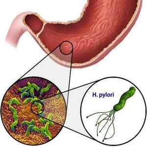 Helicobacter pylori: що це, як виявити і лікувати