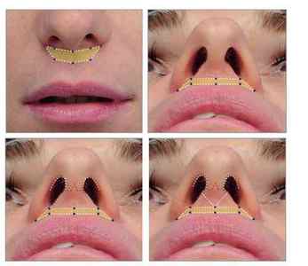 Хейлопластика (пластика губ): види, їх особливості та проведення