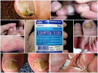 Хлоргексидин проти грибка нігтів - інструкція та відгуки