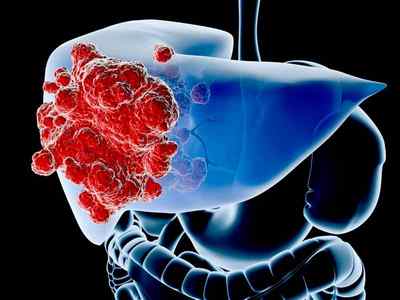Холангіоцеллюлярний рак печінки: види, симптоми, діагностика та лікування