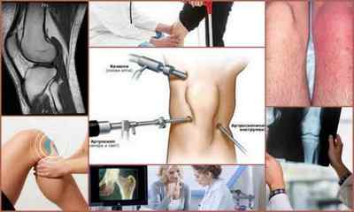 Хондромаляція надколінка і колінного суглоба: причини, симптоми, діагностика, лікування