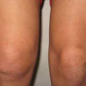 Хондроматоз колінного суглоба: симптоми і лікування тазостегнового і плечового, хондромних тіло | Ревматолог
