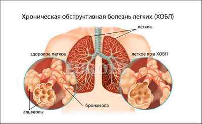 Хрипи в легенях з кашлем без температури: причини, лікування