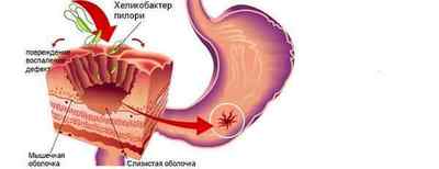 Хронічна виразка шлунка: причини, симптоми, діагностика та методи лікування