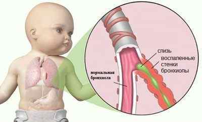 Хронічний бронхіт у дітей: симптоми і лікування