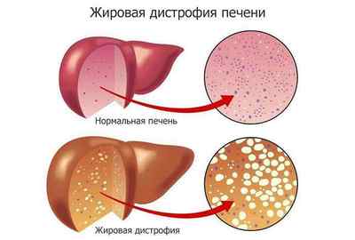 Хронічний гепатит В: скільки років з ним живуть