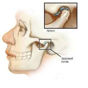 Хрумтить щелепу при відкриванні рота і жуванні в вилицях: чому і що робити | Ревматолог