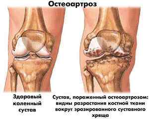Хрускіт в колінах при згинанні і розгинанні: причини і лікування, що робити з суглобом | Ревматолог
