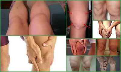 Хвороба Гоффа колінного суглоба: причини, симптоми, лікування