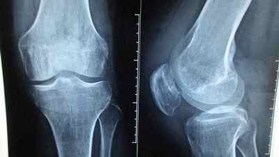 Хвороба Кеніга колінного суглоба: лікування рассекающего остеохондріта у дітей і дорослих, причини хвороби у спортсменів, народні засоби | Ревматолог