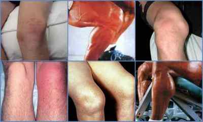 Хвороба Шляттера колінного суглоба у підлітків, дорослих і дітей - симптоми і лікування