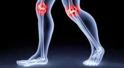 Хвороби колінного суглоба: які бувають види, симптоми і лікування, як називаються і який лікар лікує, діагноз Пеллегріні Штіда | Ревматолог