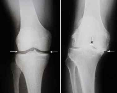 Хвороби колінного суглоба: які бувають види, симптоми і лікування, як називаються і який лікар лікує, діагноз Пеллегріні Штіда | Ревматолог