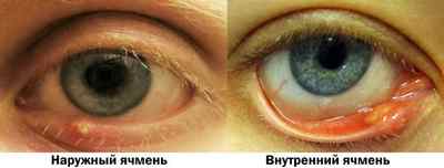 Хвороби століття очей (нижнього і верхнього): опис захворювань у людини, симптоми, лікування