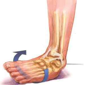 Хвороби суглобів стопи ніг: симптоми і лікування гомілковостопного суглоба, хвороба Леддерхозе на лівій стопі | Ревматолог