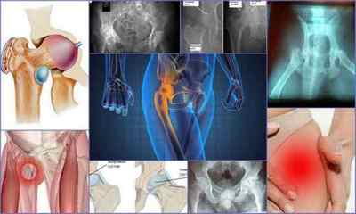 Хвороби тазостегнового суглоба: симптоми, фото, лікування (вправа, уколи, таблетки, мазі, види операцій)