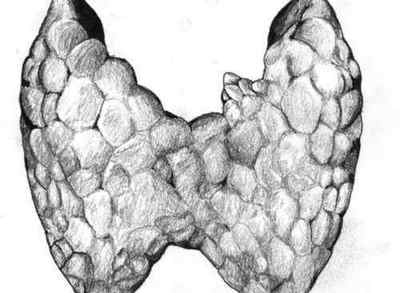 Кальцинати в щитовидній залозі: що це таке?