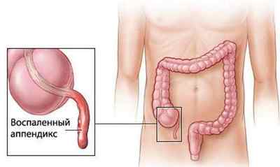 Калікоектазія (гідрокалікоз) лівої і правої нирки: що це таке