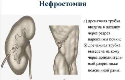 Калікоектазія (гідрокалікоз) лівої і правої нирки: що це таке